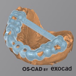 GUIDED SURGERY - OS-CAD  BY EXOCAD